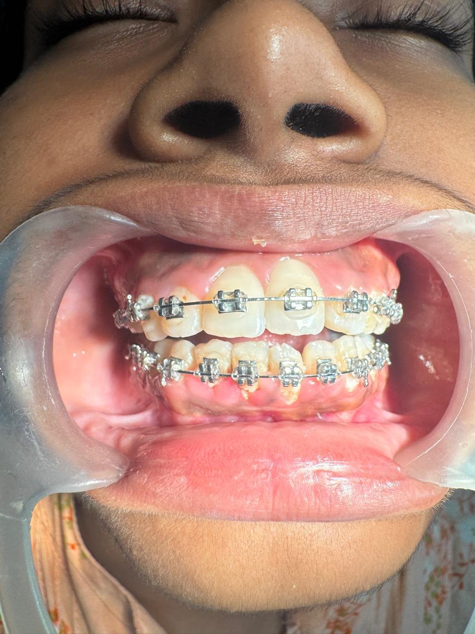 Orthodontics Alignment